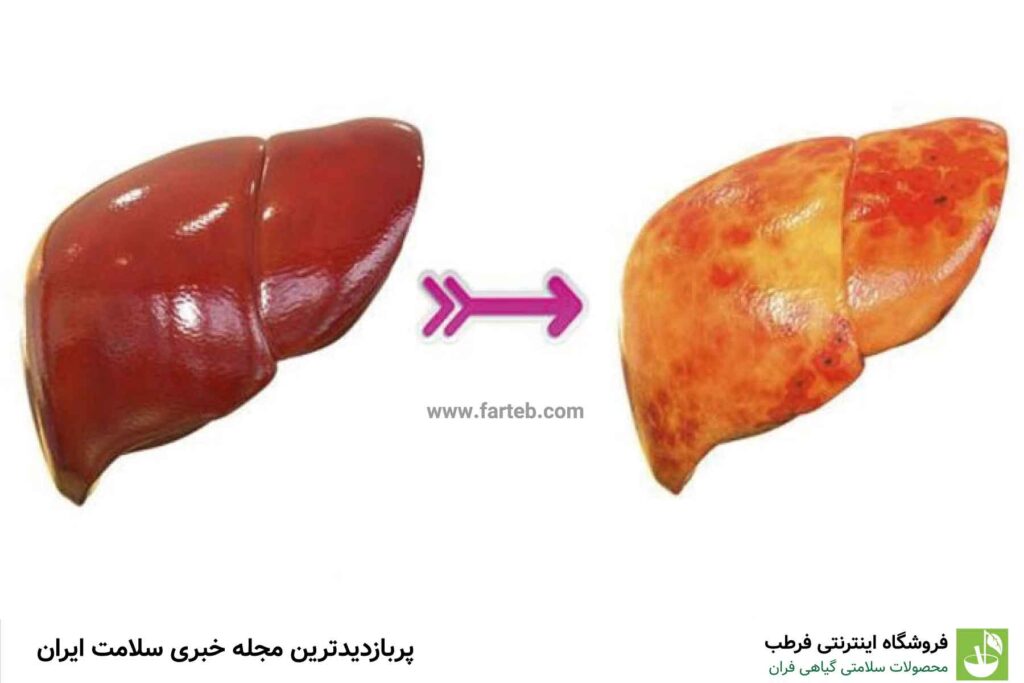 علائم کبد چرب