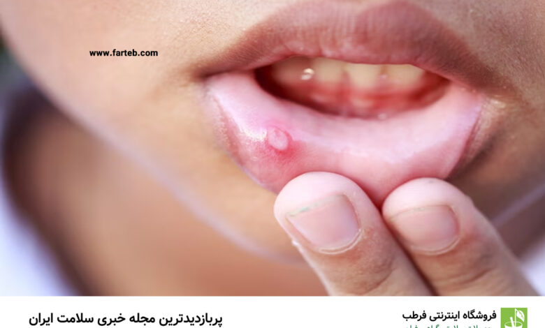 آفت دهان