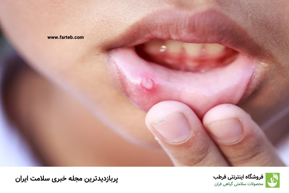 آفت دهان