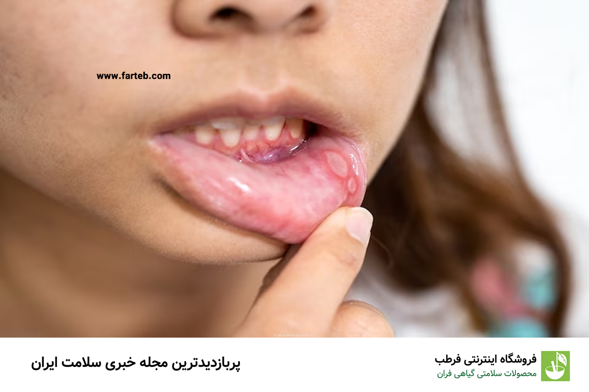 دلایل و نشانههای آفت دهان