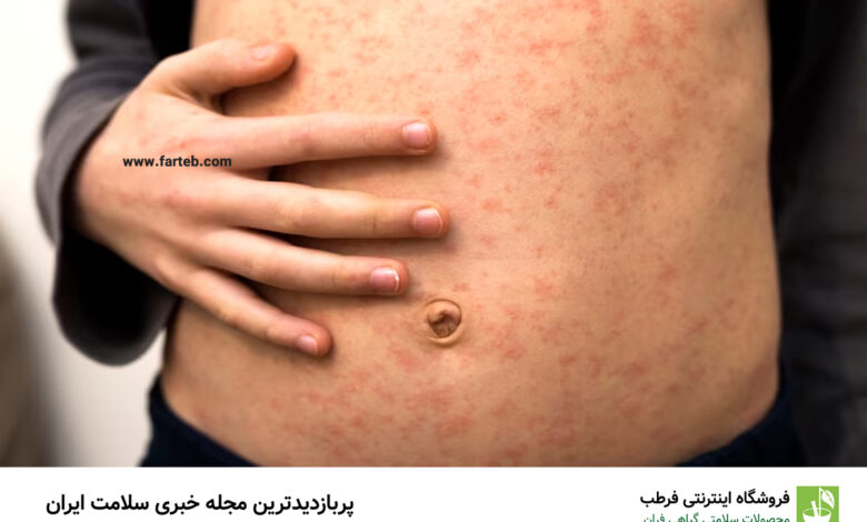 آبله مرغان چیست؟
