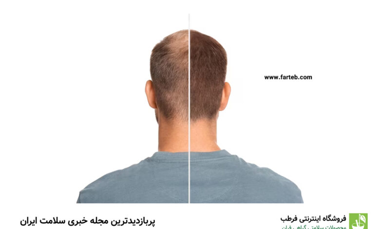 درمان خانگی کم پشتی مو