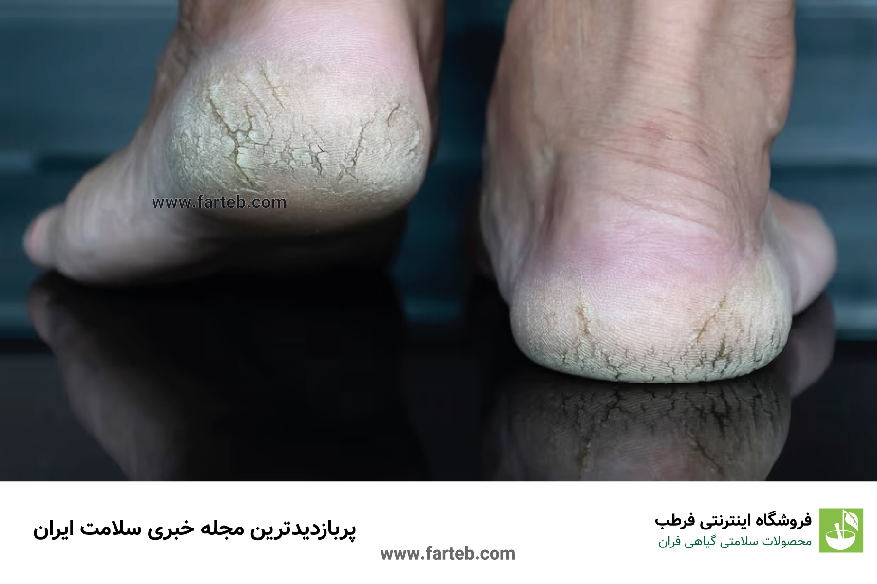پاشنه خشک و ترک‌خورده: کمبود امگا ۳ و مشکلات کبدی