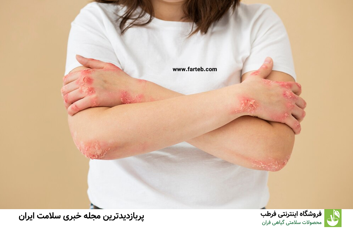 نشانه‌های بیماری کبد روی پوست دست‌ها: شناسایی و درمان