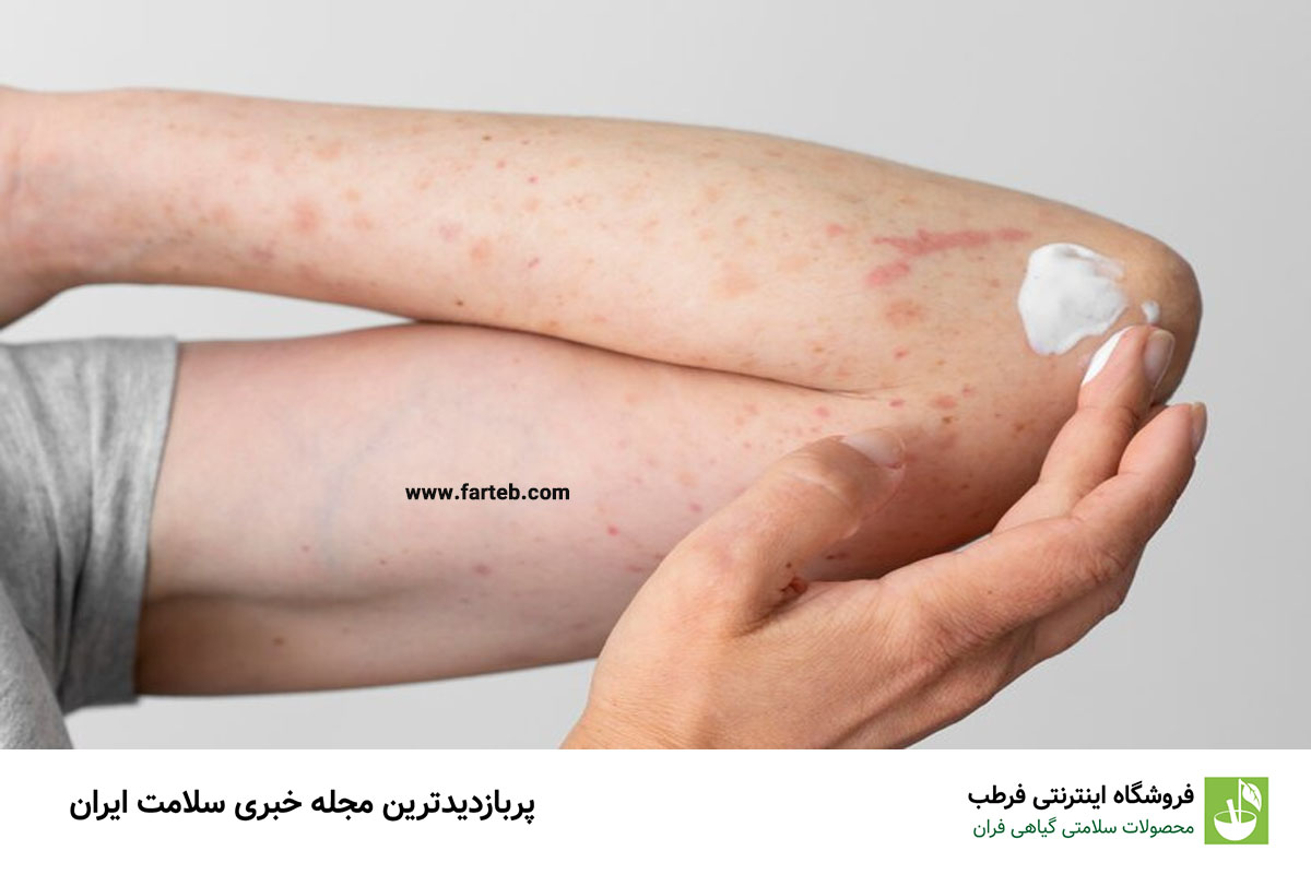 شایعترین سن برای ابتلا به آبله مرغان چه سنی است؟
