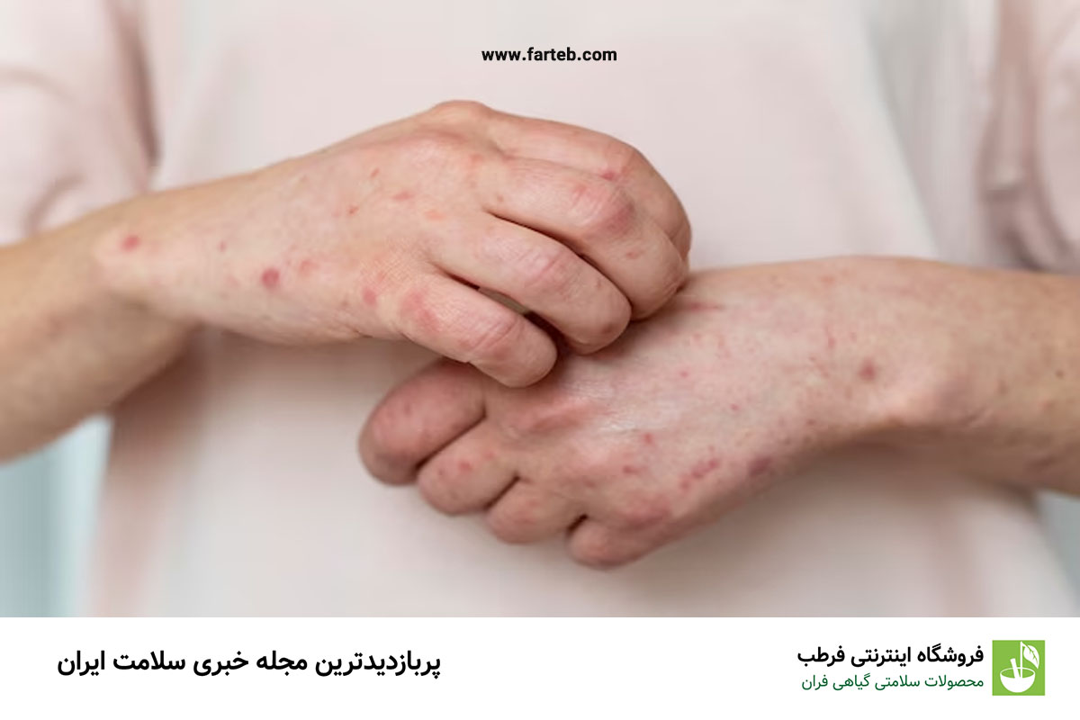 شایعترین سن برای ابتلا به آبله مرغان چه سنی است؟