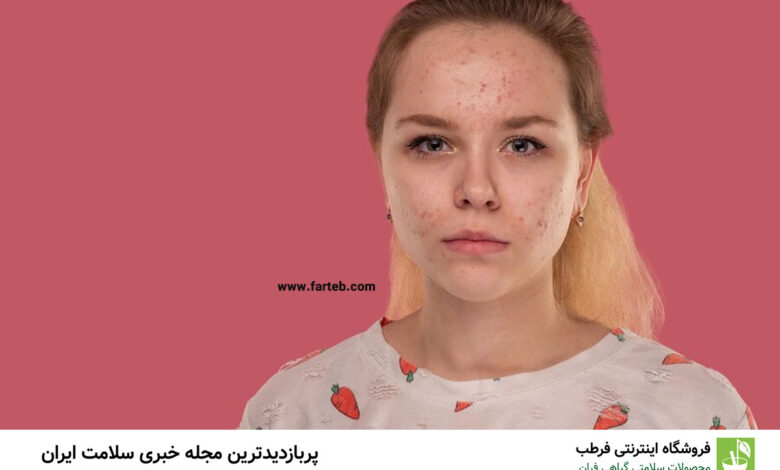 چه بخوریم تا جوش نزنیم؟