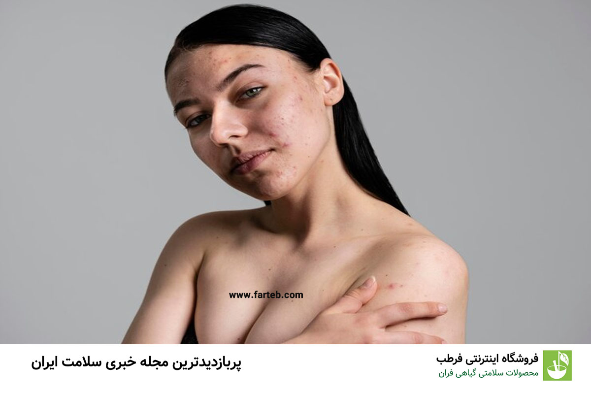 چه بخوریم تا جوش نزنیم؟