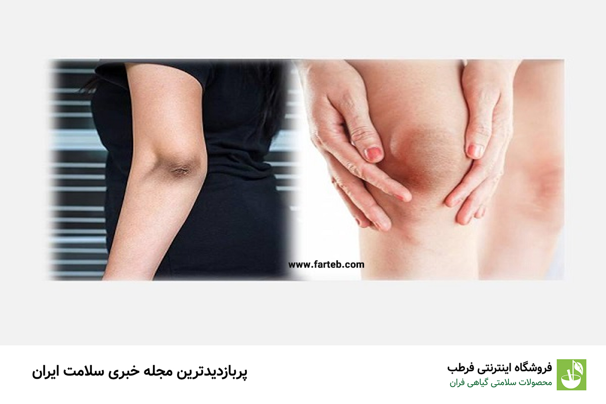 راهنمای کامل برای درمان تیرگی پوست زانو و آرنج: روشها و تکنیکهای اثبات شده