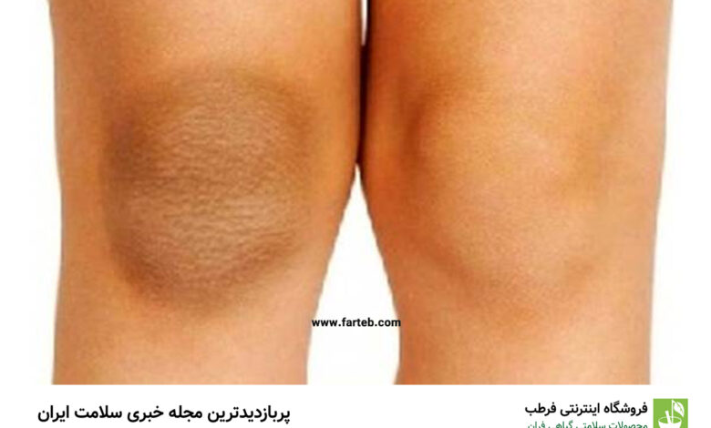 راهنمای کامل برای درمان تیرگی پوست زانو و آرنج: روش‌ها و تکنیک‌های اثبات شده