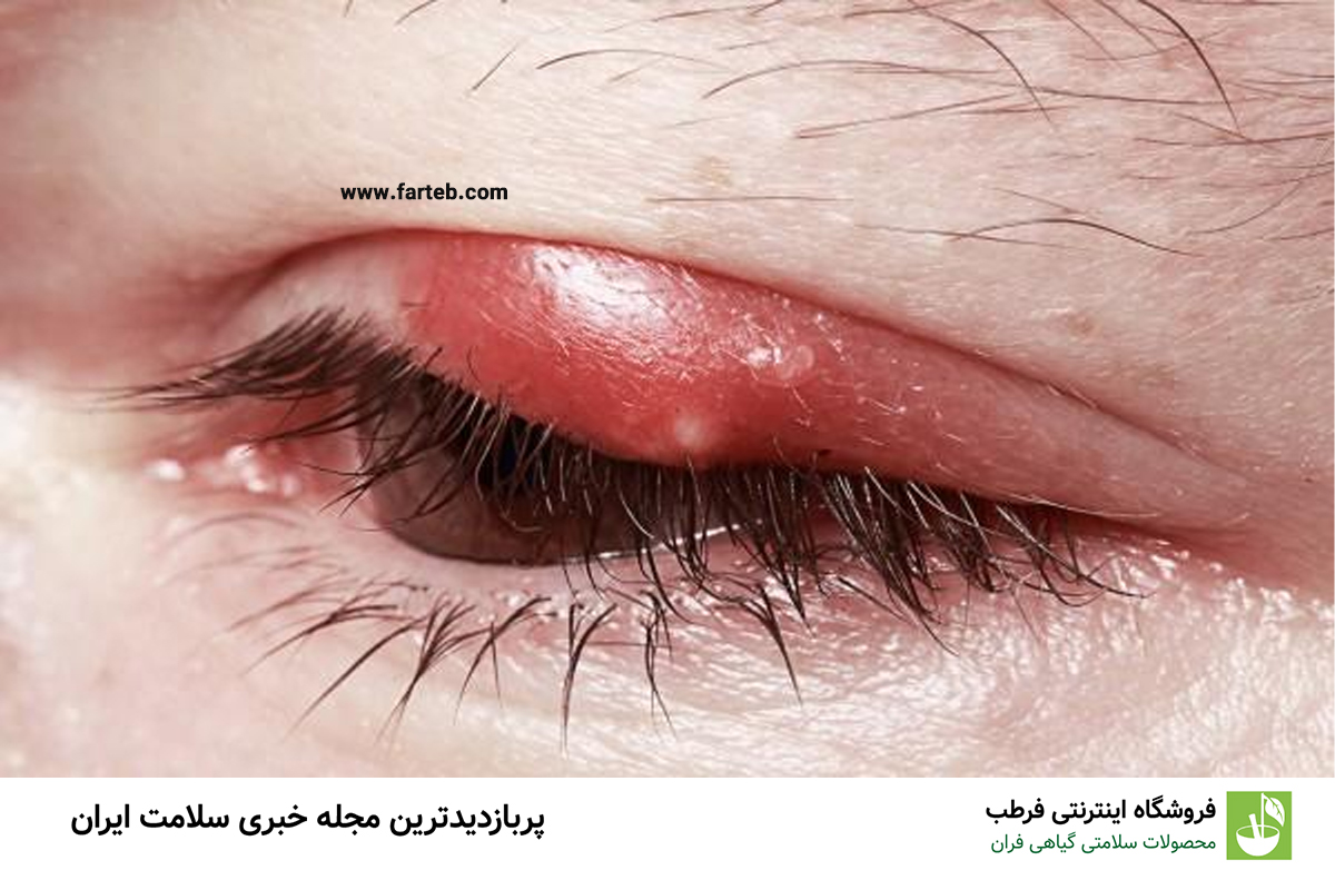 چگونه گل مژه را سریع و ایمن درمان کنیم؟ روش‌های پزشکی و خانگی
