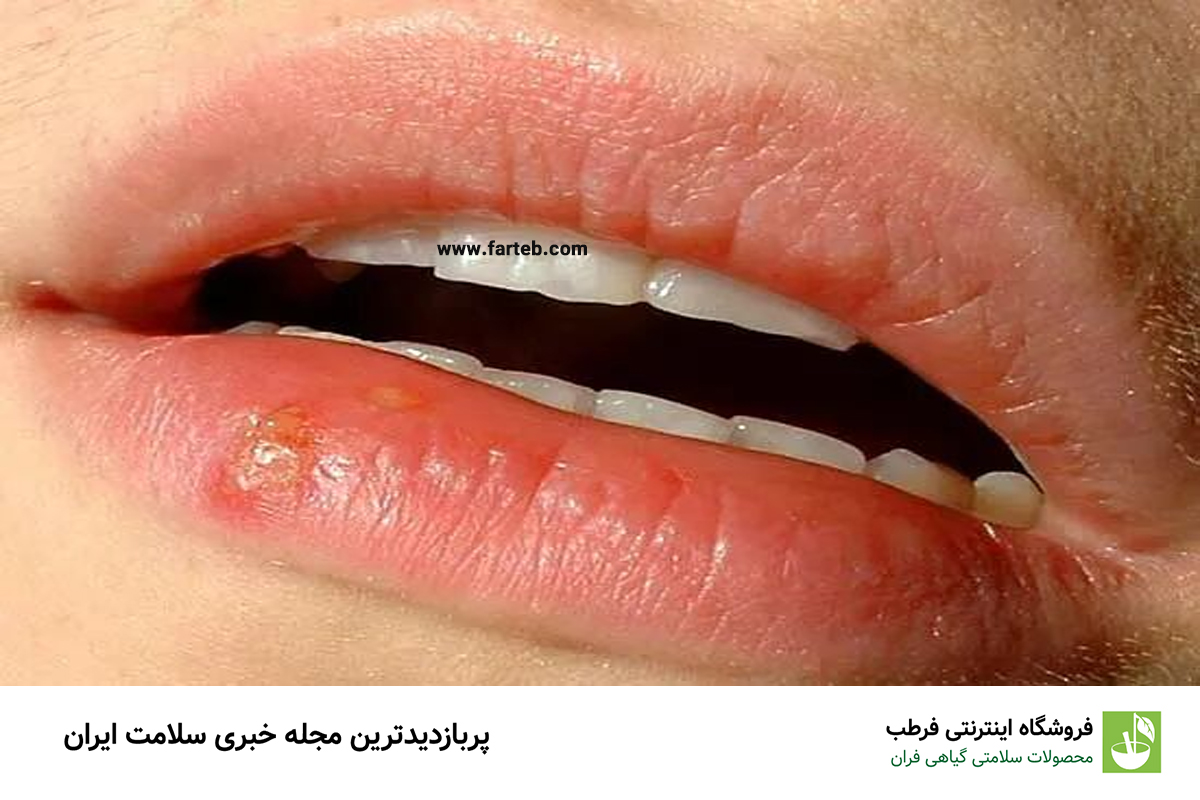 راهکارهای مؤثر برای درمان تبخال و پیشگیری از بازگشت آن