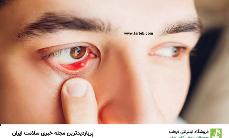 چگونه گل مژه را سریع و ایمن درمان کنیم؟ روش‌های پزشکی و خانگی