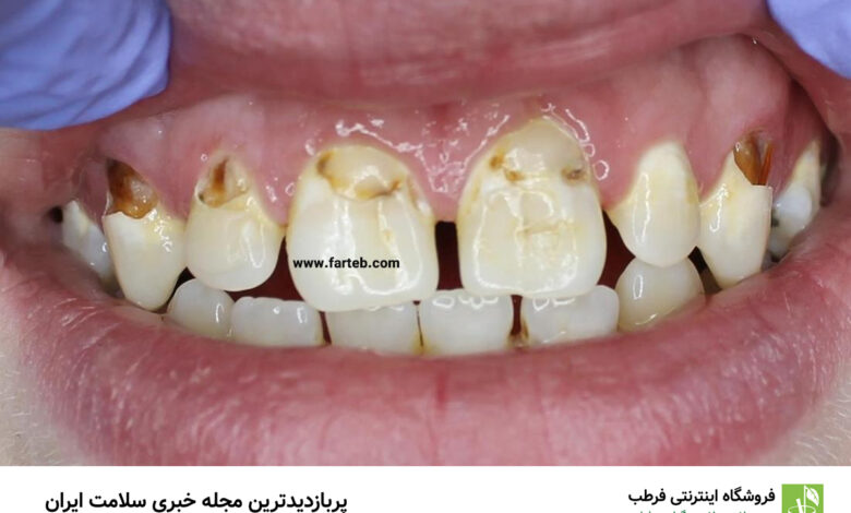 اهنمای کامل برای درمان پوسیدگی دندان: از پیشگیری تا روش‌های نوین
