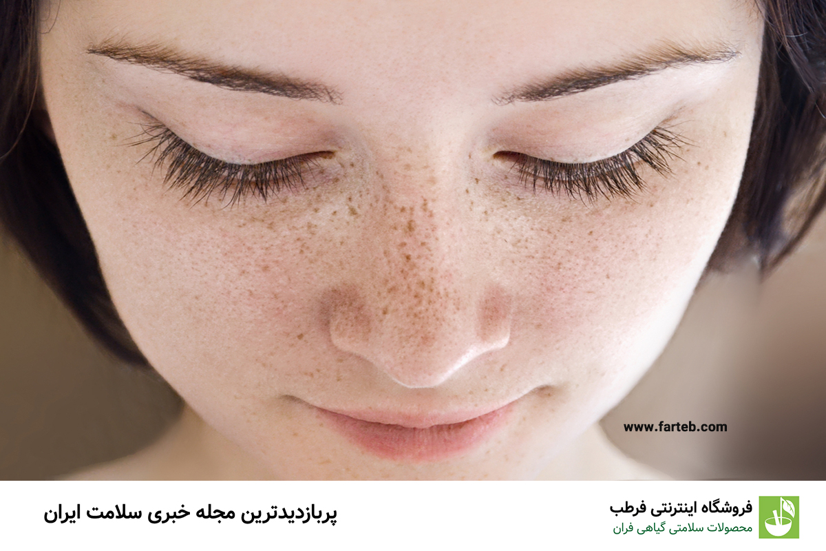 راهکارهای موثر خانگی برای از بین بردن کک و مک: نکات کلیدی برای پوستی زیبا