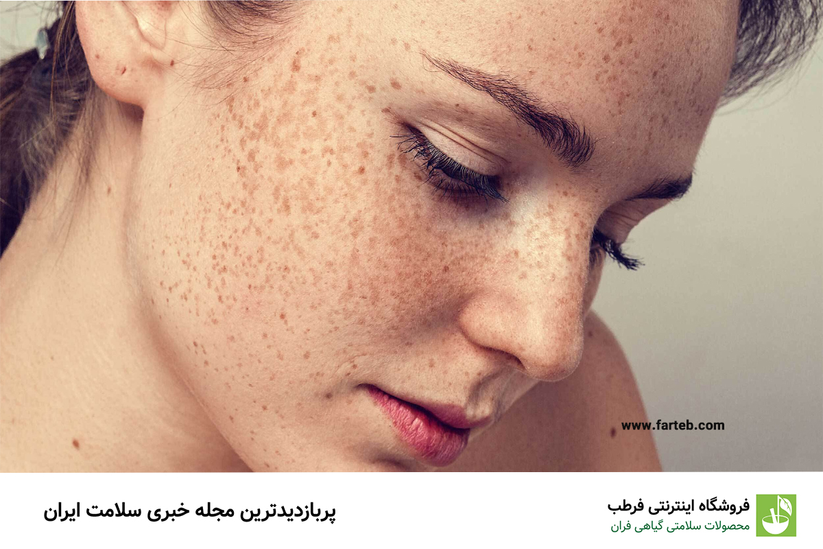 راهکارهای موثر خانگی برای از بین بردن کک و مک: نکات کلیدی برای پوستی زیبا