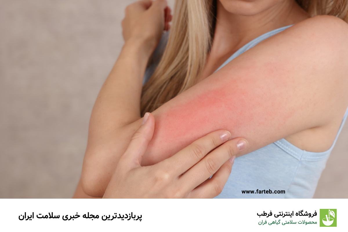 راهنمای جامع آلرژیهای پوستی: علل، روشهای تشخیص و بهترین روشهای درمان