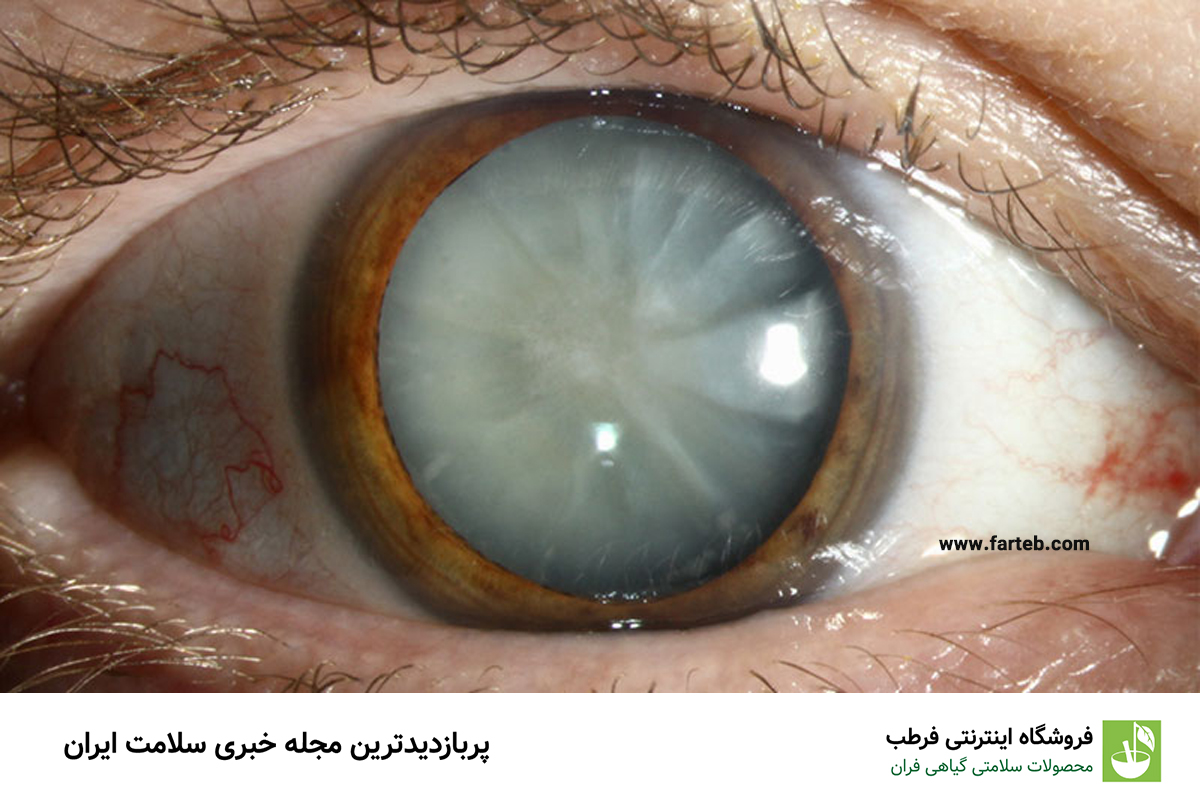 چگونه علائم آب مروارید را تشخیص دهیم؟ راهنمای کامل شناسایی و درمان