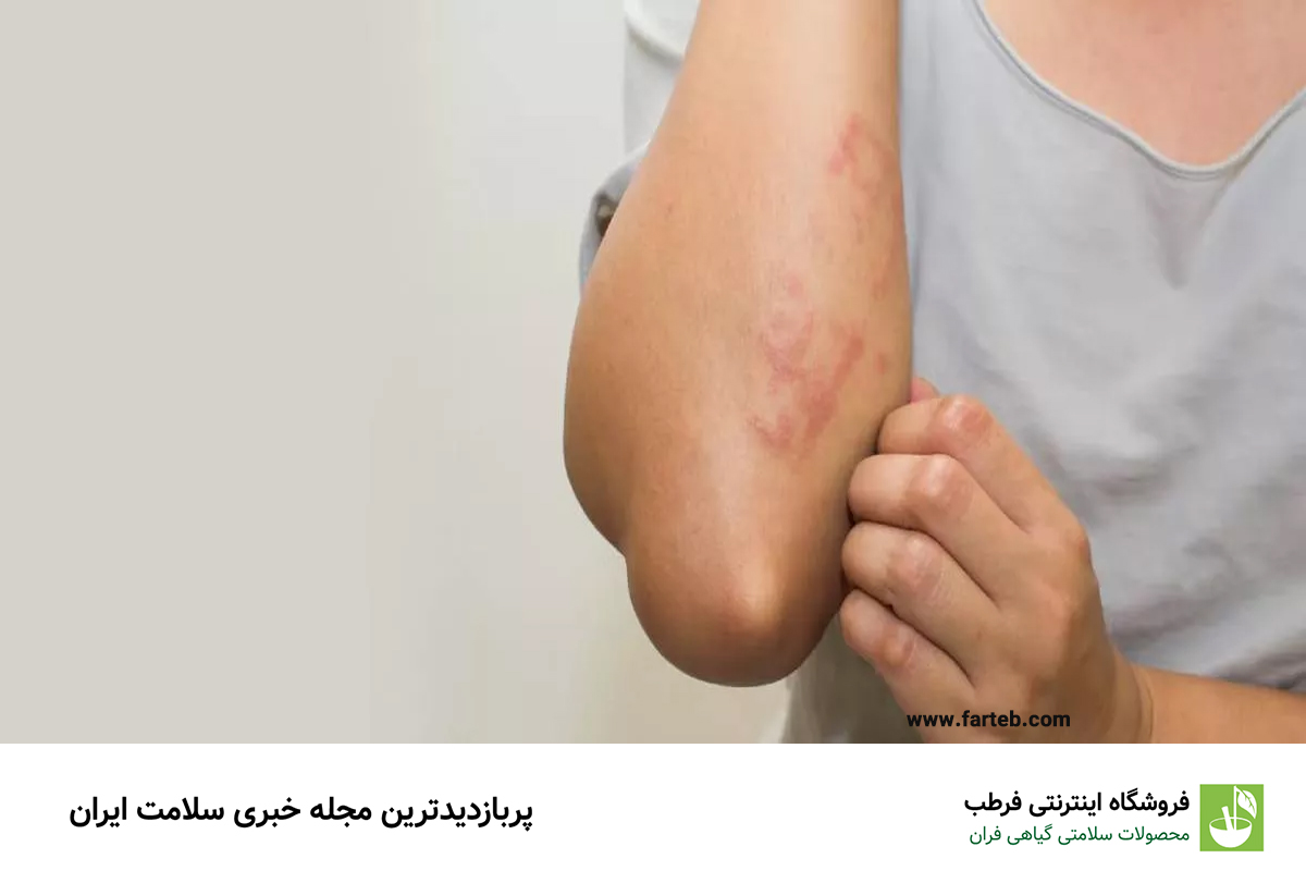 راهنمای جامع آلرژیهای پوستی: علل، روشهای تشخیص و بهترین روشهای درمان