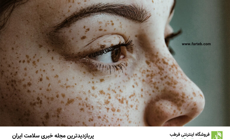 راهکارهای موثر خانگی برای از بین بردن کک و مک: نکات کلیدی برای پوستی زیبا
