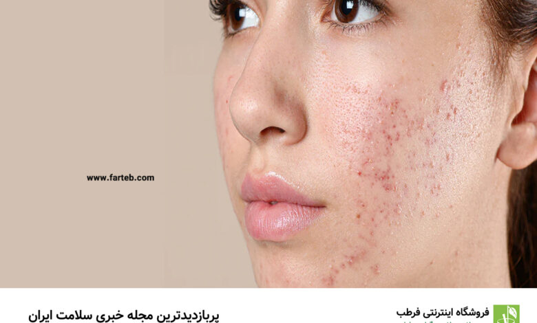راهنمای کامل آرایش برای پوست چرب و آکنه‌دار: ۵ ترفند طلایی برای زیبایی بی‌نقص