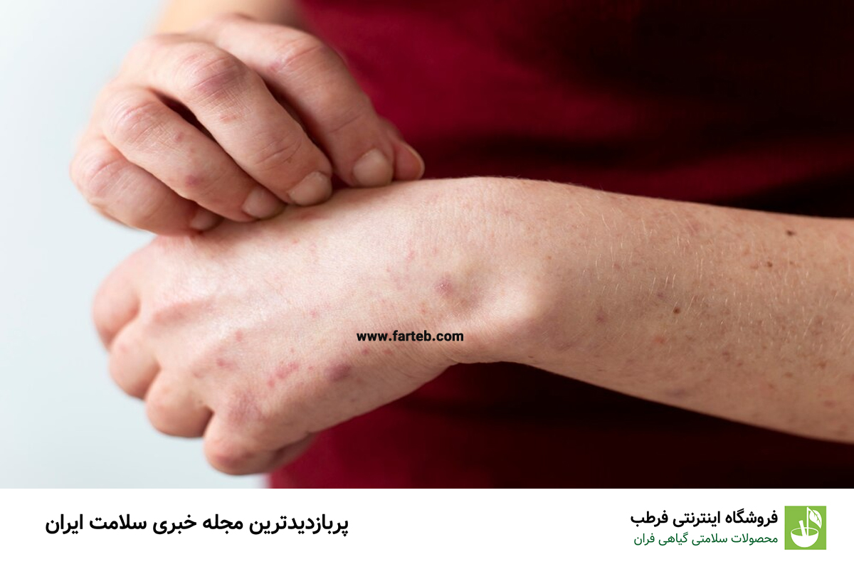 نشانه‌های خطرناک خارش پوست: چگونه بفهمیم خارش ما نگران‌کننده است؟