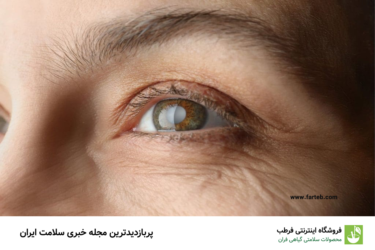 چگونه علائم آب مروارید را تشخیص دهیم؟ راهنمای کامل شناسایی و درمان