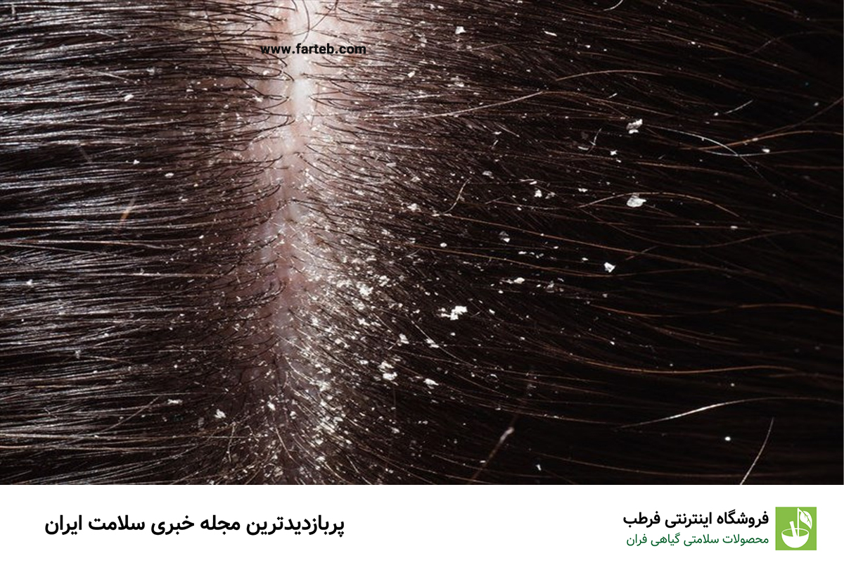 سه اختلال رایج پوست سر با علائم مشابه شوره: شناسایی و درمان