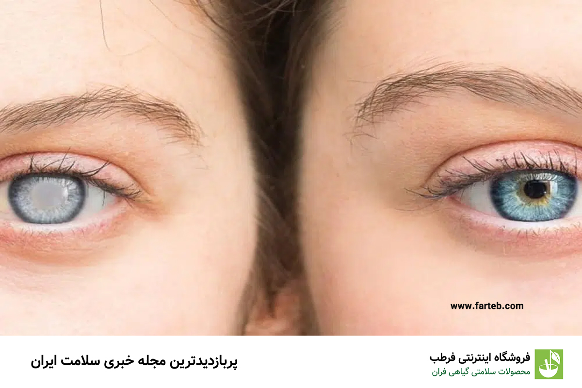 چگونه علائم آب مروارید را تشخیص دهیم؟ راهنمای کامل شناسایی و درمان