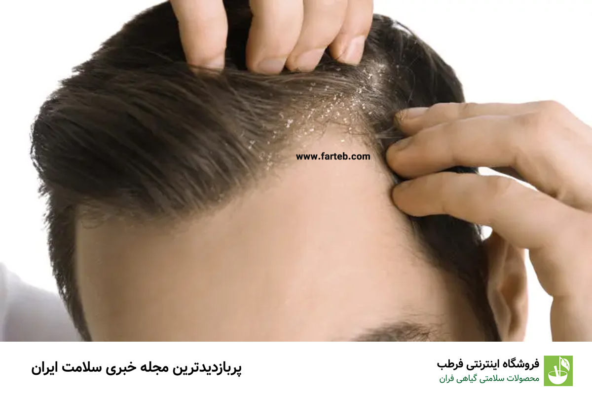 سه اختلال رایج پوست سر با علائم مشابه شوره: شناسایی و درمان