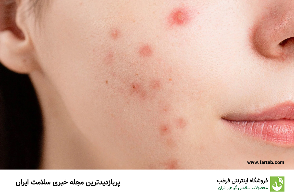 راهنمای کامل آرایش برای پوست چرب و آکنه‌دار: ۵ ترفند طلایی برای زیبایی بی‌نقص