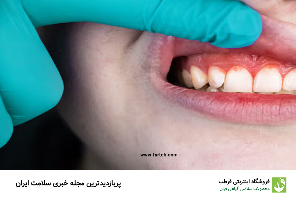راهنمای کامل برای درمان التهاب لثه: روش‌های مؤثر و توصیه‌های کاربردی