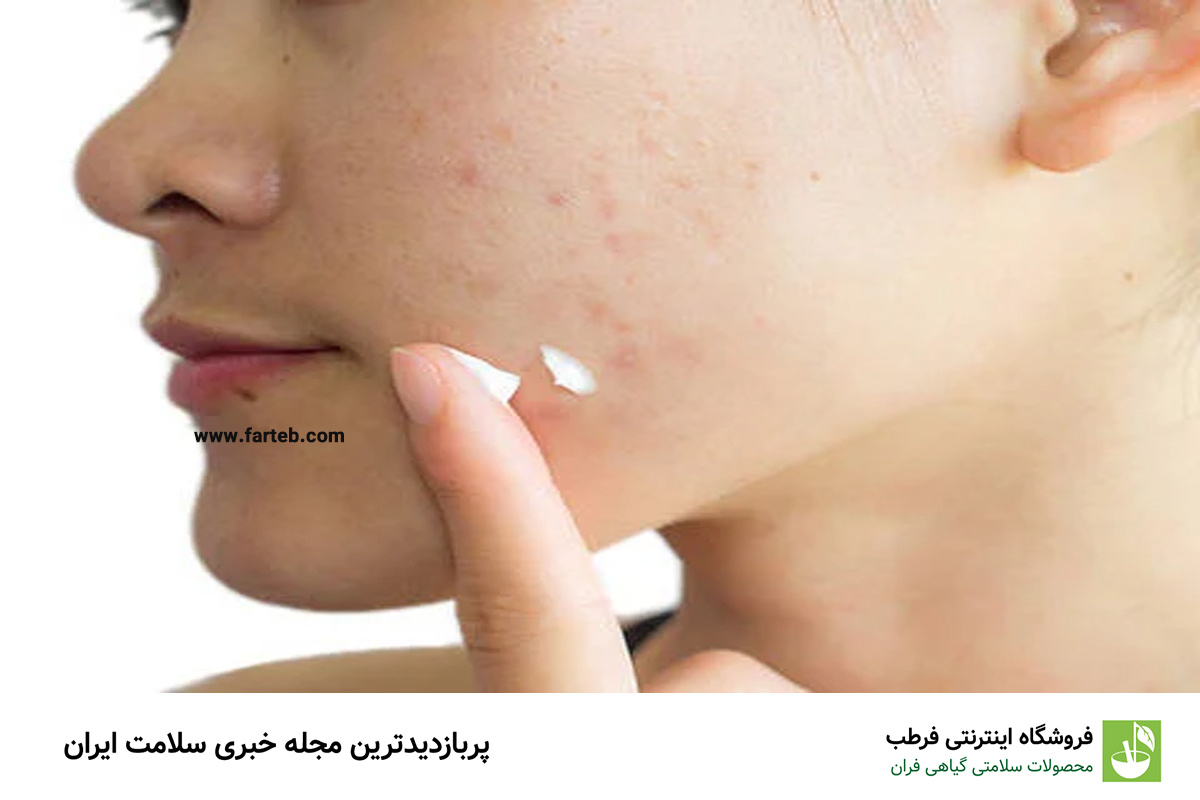 راهنمای کامل آرایش برای پوست چرب و آکنه‌دار: ۵ ترفند طلایی برای زیبایی بی‌نقص