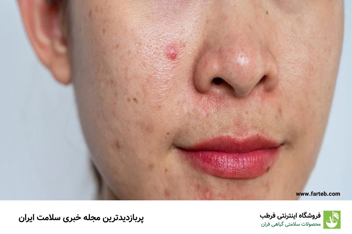 راهنمای کامل آرایش برای پوست چرب و آکنه‌دار: ۵ ترفند طلایی برای زیبایی بی‌نقص