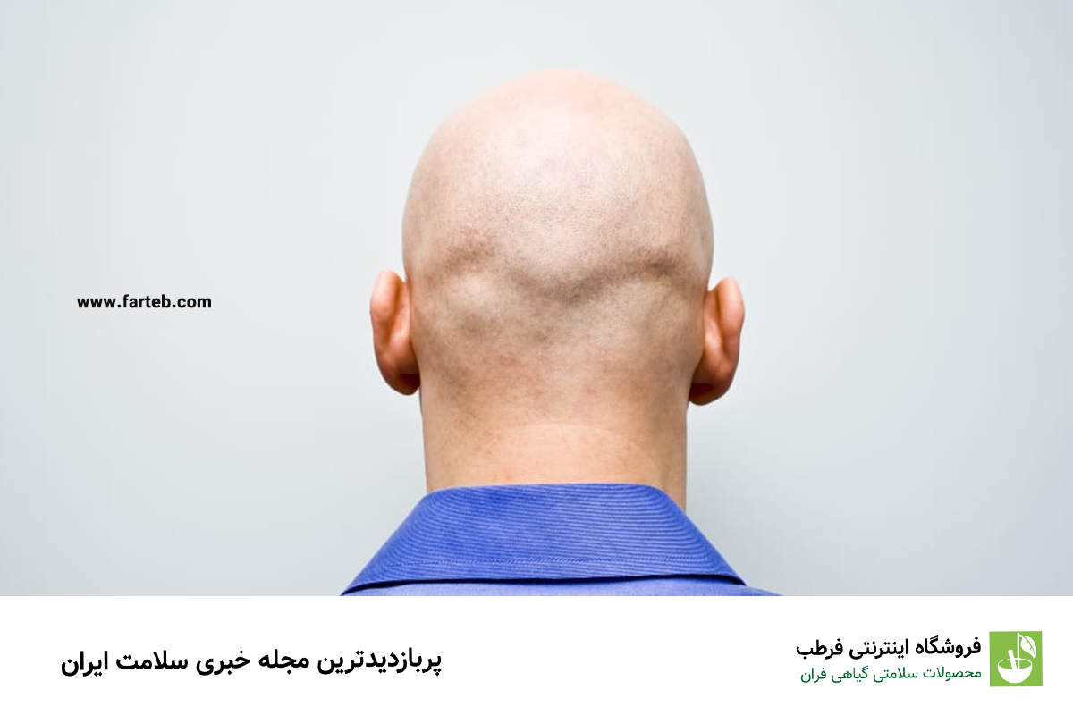 گنجی که فقط کچل‌ها دارند