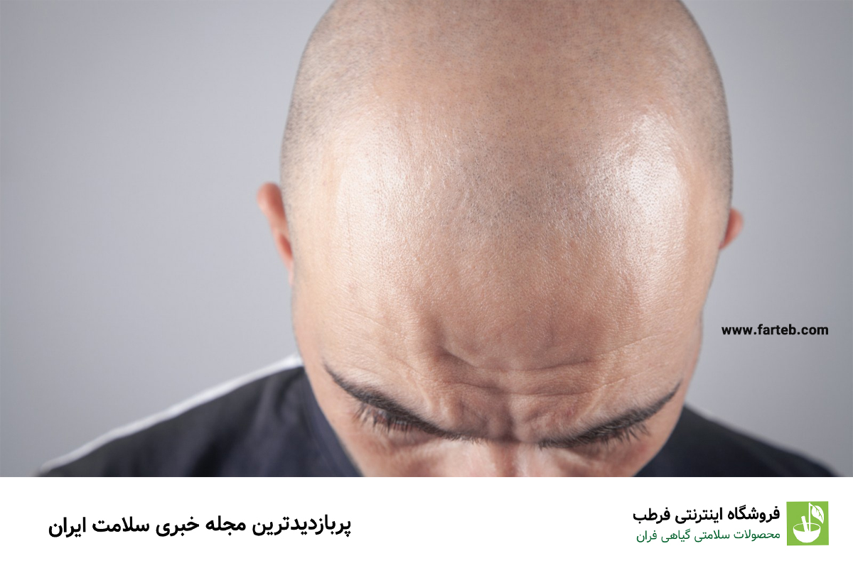گنجی که فقط کچل‌ها دارند