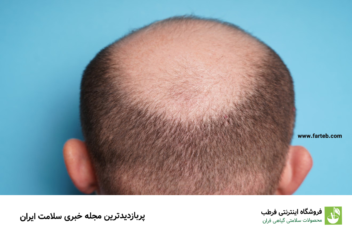 گنجی که فقط کچل‌ها دارند