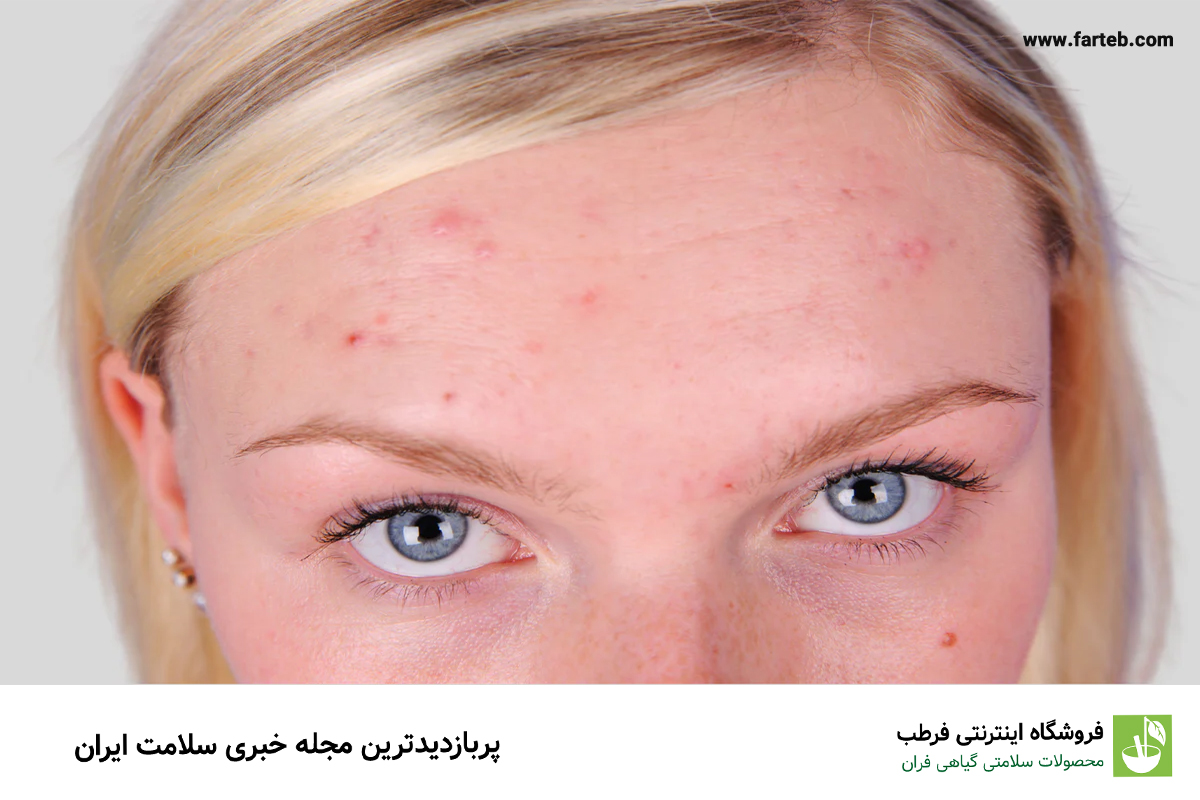 علت جوش پیشانی چیست و چگونه درمان می‌شود؟