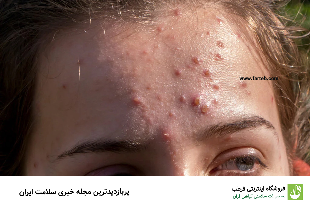 علت جوش پیشانی چیست و چگونه درمان می‌شود؟