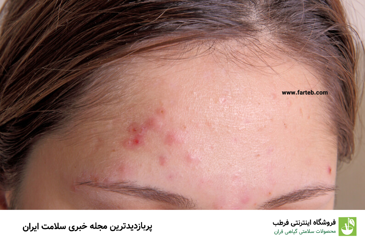 علت جوش پیشانی چیست و چگونه درمان می‌شود؟