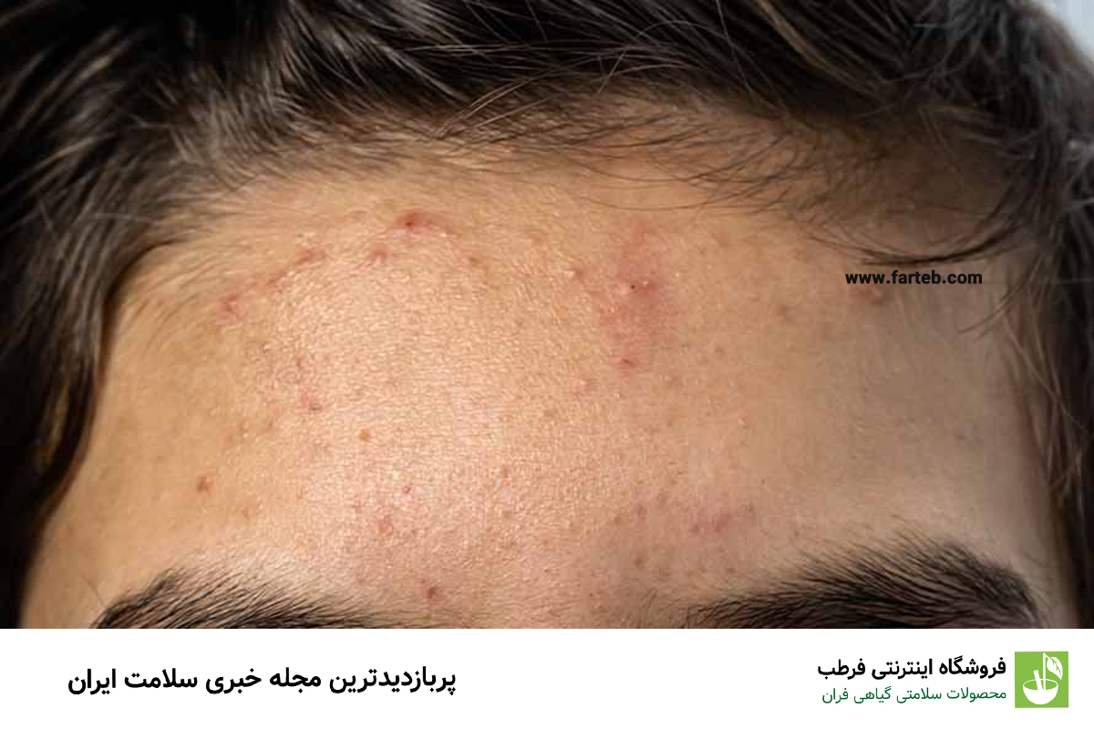 علت جوش پیشانی چیست و چگونه درمان می‌شود؟