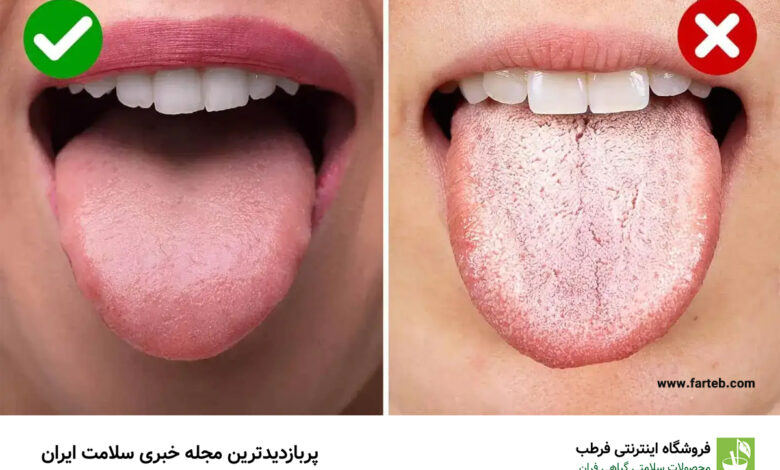 دلیل زبان سفید رنگ چیست ؟