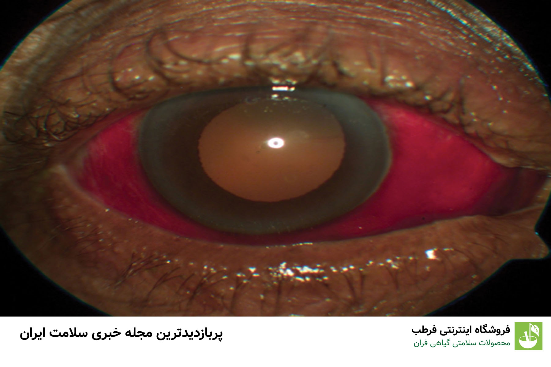 عفونت