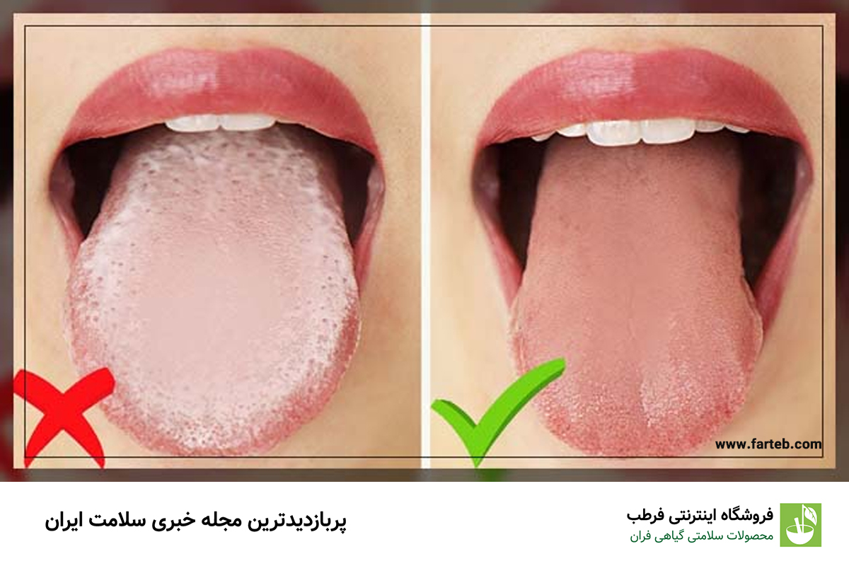 دلیل زبان سفید رنگ چیست ؟