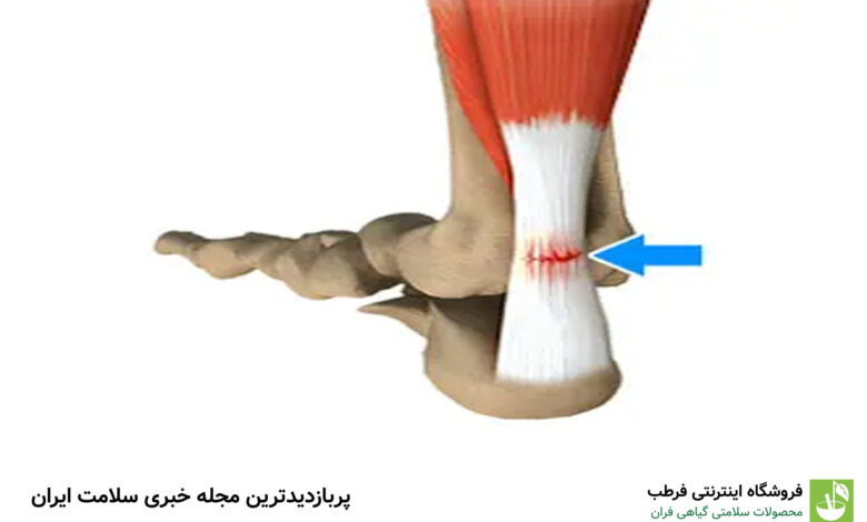 پارگی تاندون چیست و چگونه درمان می شود؟