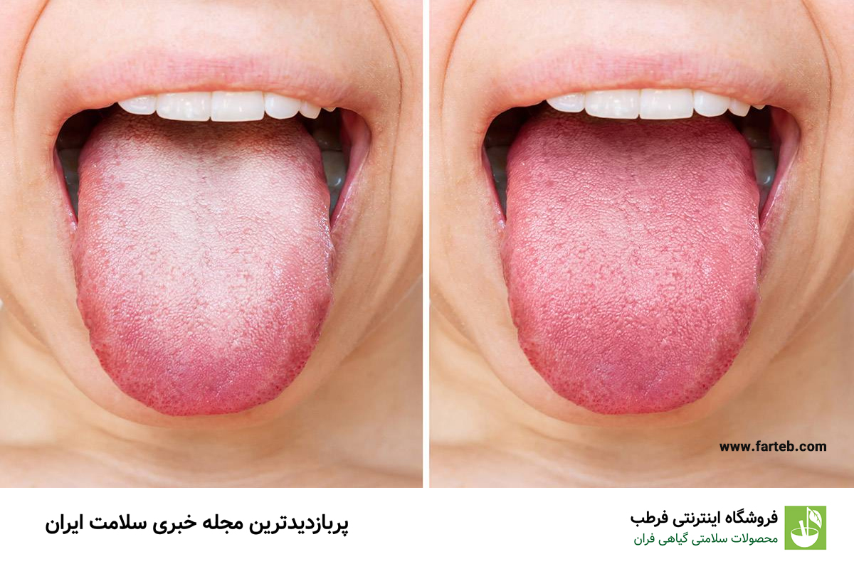 دلیل زبان سفید رنگ چیست ؟