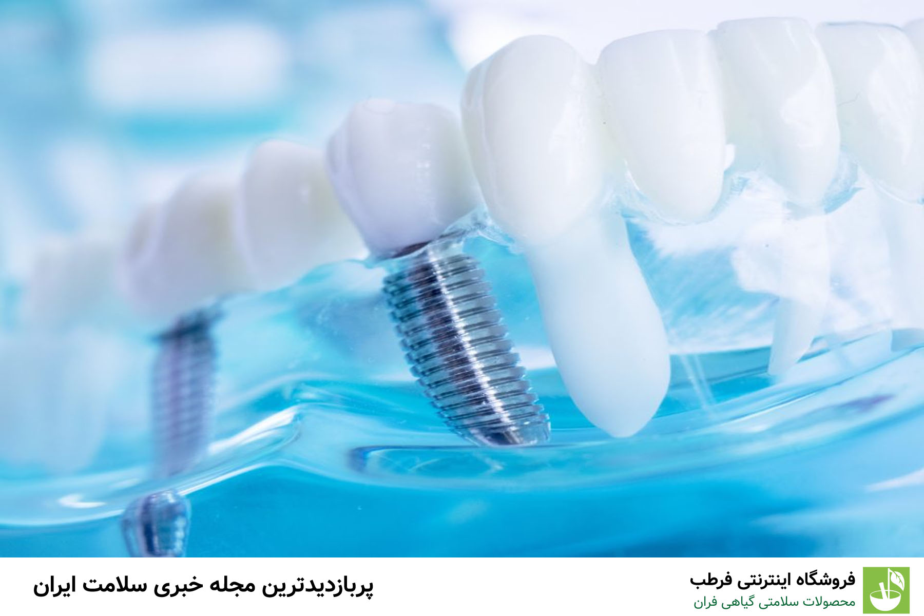نکات مهم در مراقبت قبل و بعد از ایمپلنت دندان