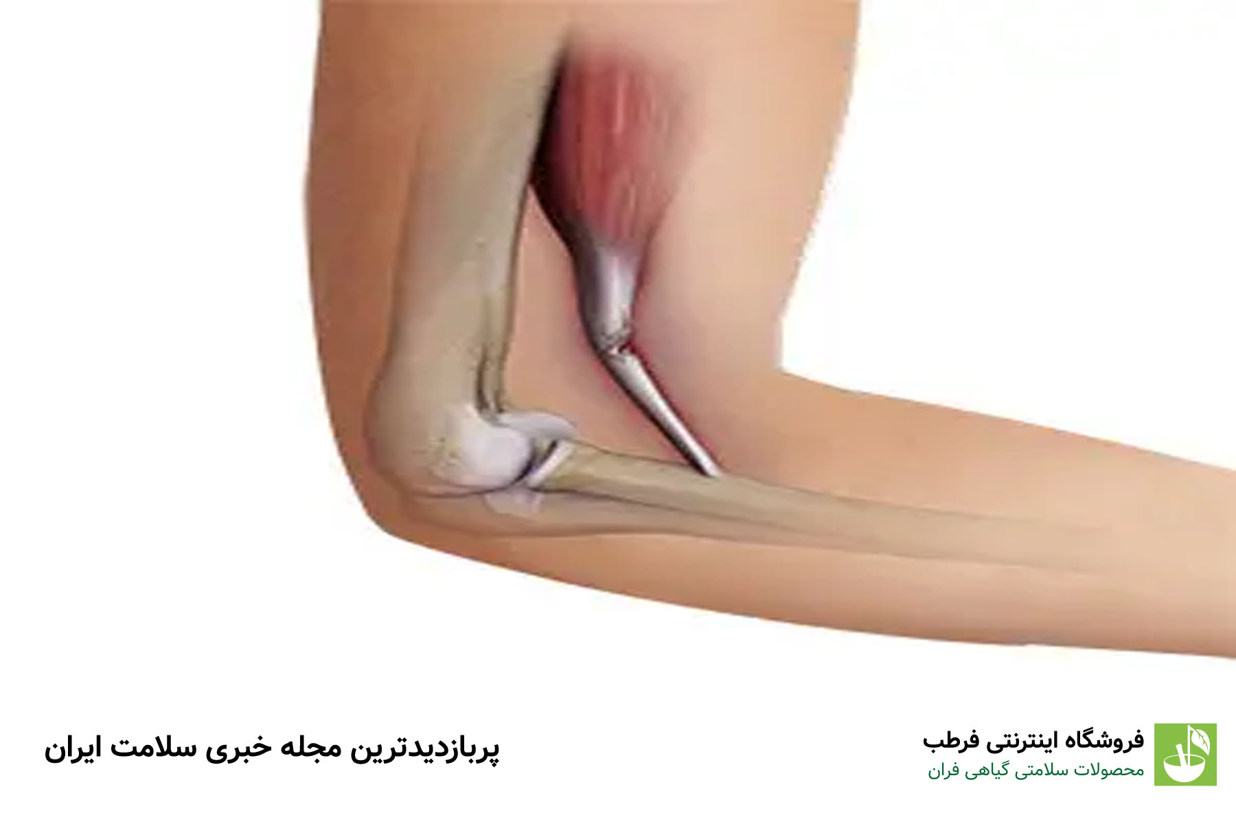 درمان پارگی تاندون
