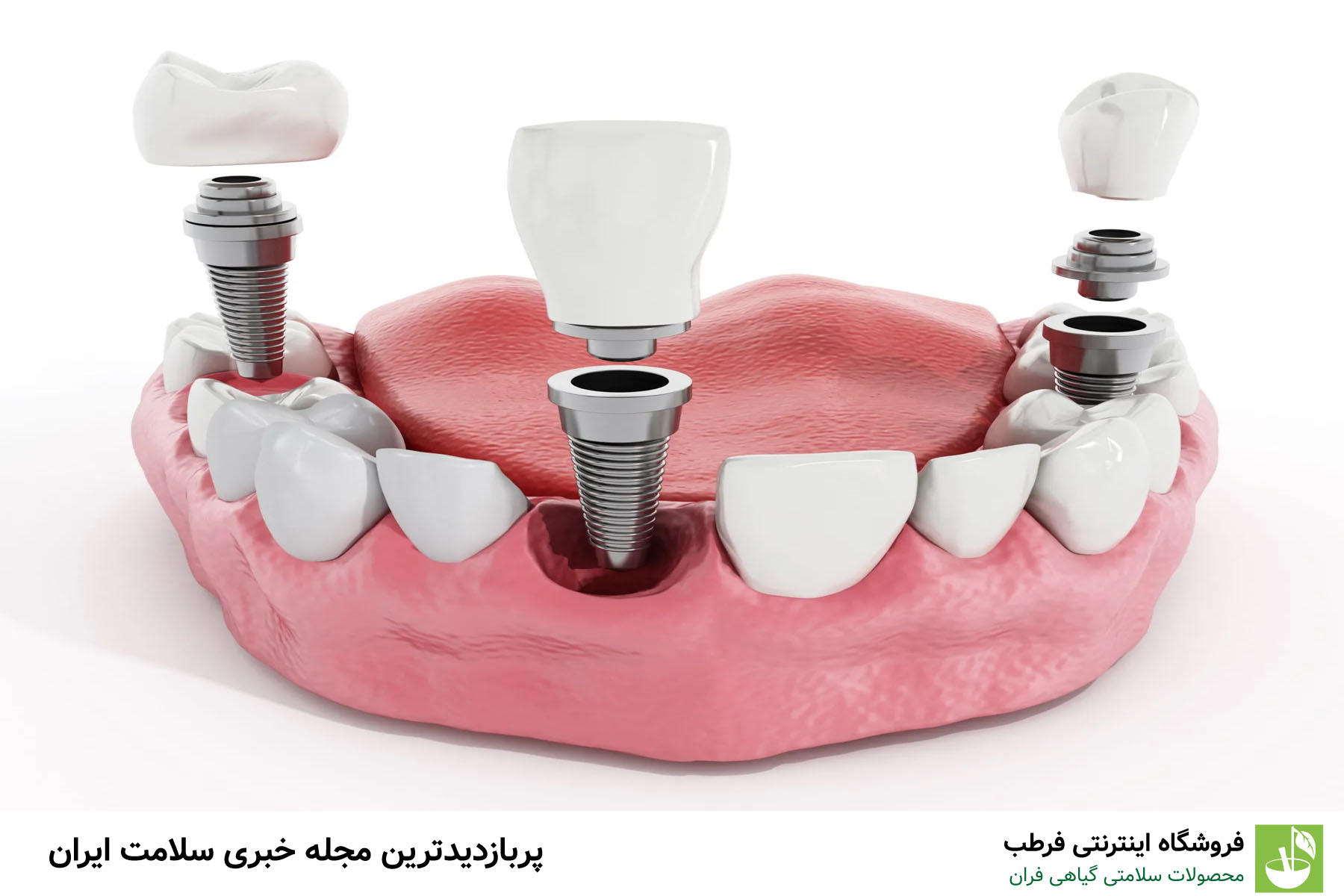 نکات مهم در مراقبت قبل و بعد از ایمپلنت دندان