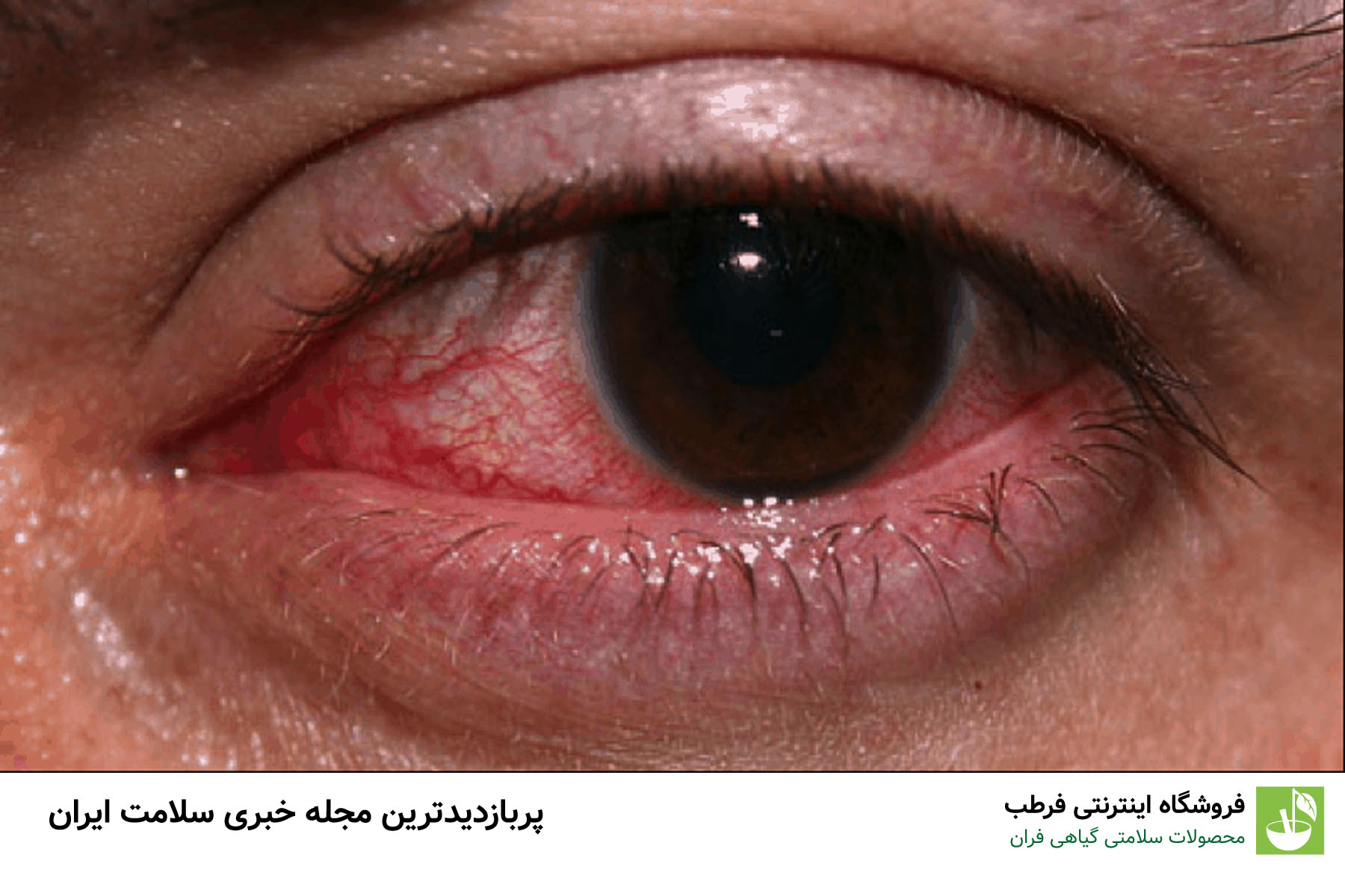 4. عفونت و التهاب
